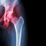 xray hip